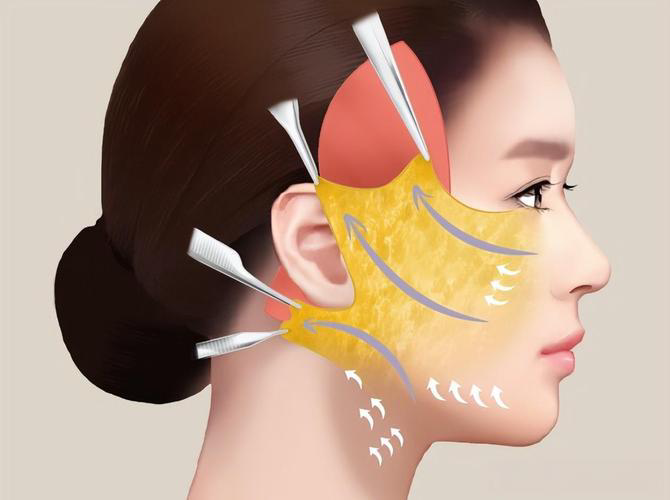 成都李建剛筋膜提升靠譜嗎