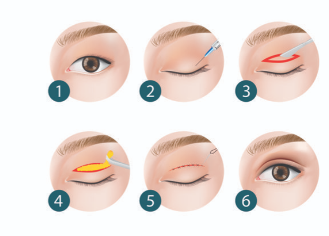 張霞飛雙眼皮價(jià)格多少？杭州格萊美整形醫(yī)院雙眼皮價(jià)目表公開，含修復(fù)案例分享