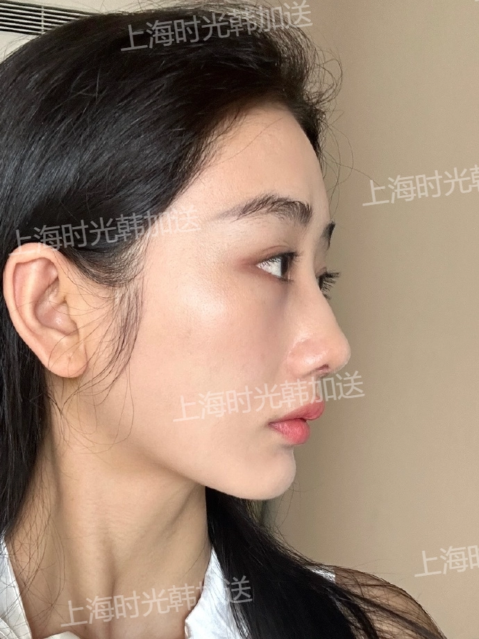 小切口提升是什么？它有哪些優(yōu)勢？