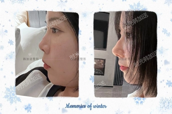 如何選擇上海徐懷河進行小切口提升手術？