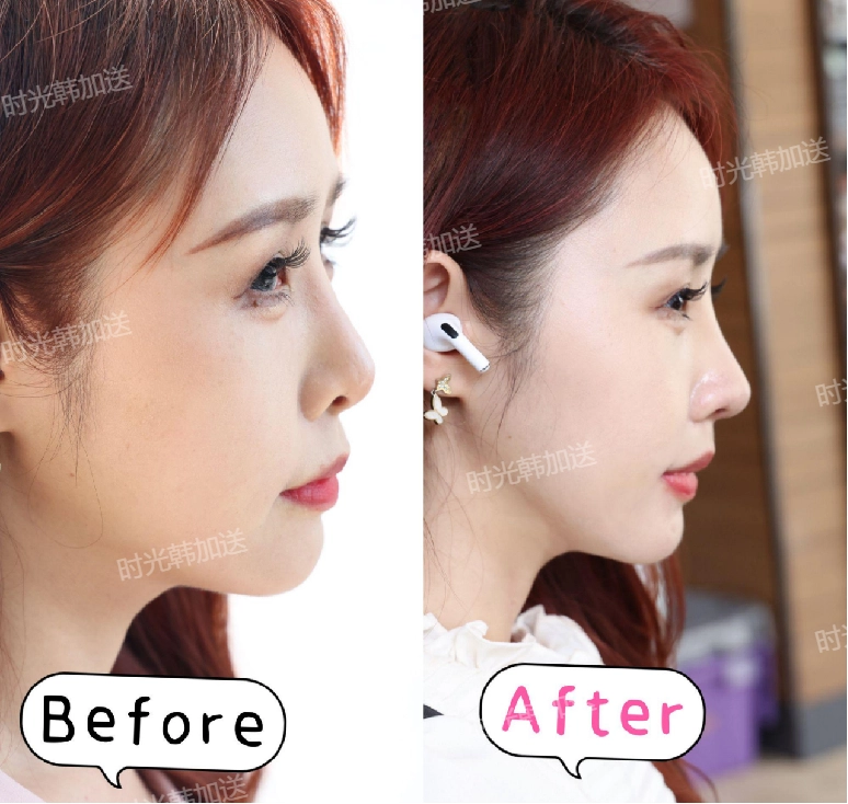 徐懷河醫(yī)生拉皮提升的優(yōu)勢有哪些？