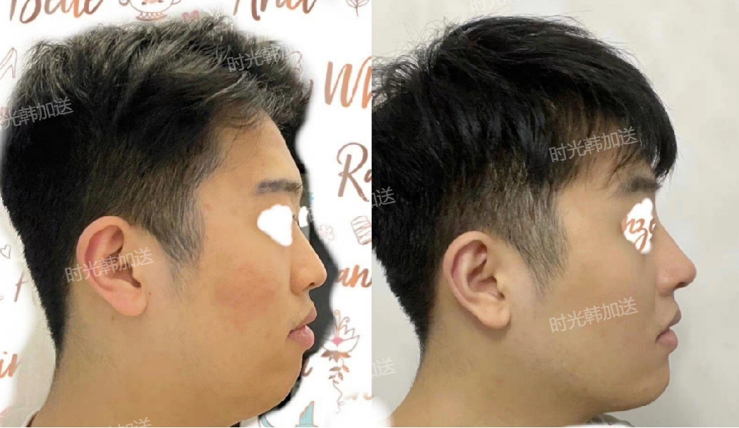 上海時(shí)光醫(yī)院拉皮提升項(xiàng)目綜合情況