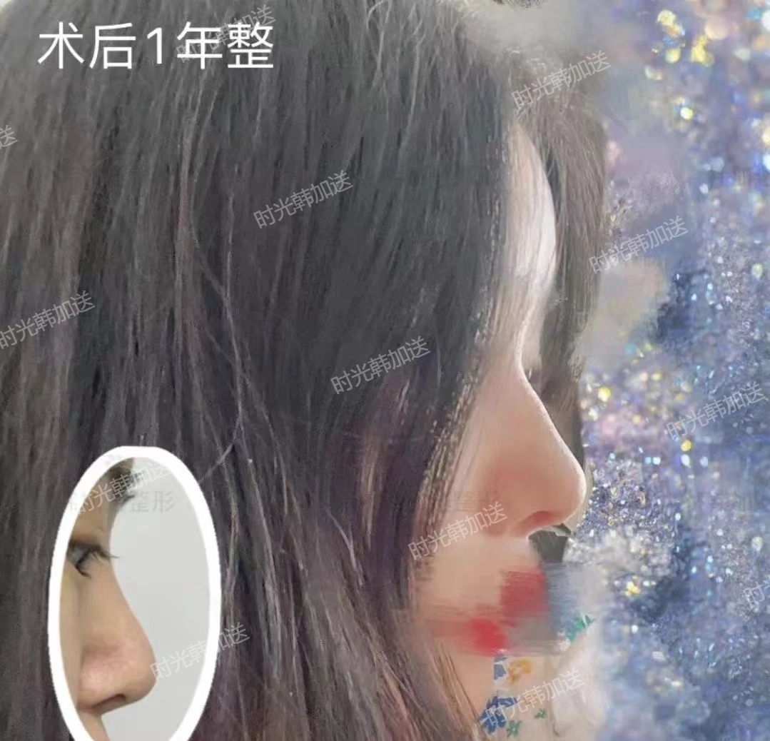 如何選擇適合自己的拉皮提升方案？