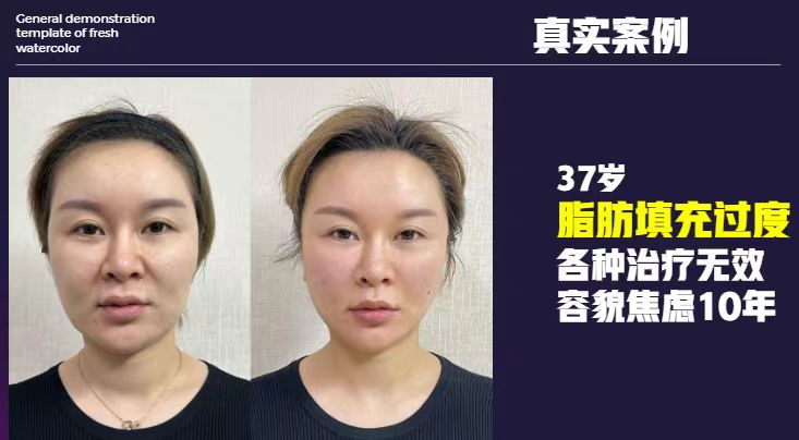 成都藝星醫(yī)療美容醫(yī)院：復(fù)合技術(shù)，應(yīng)對頑固疤痕