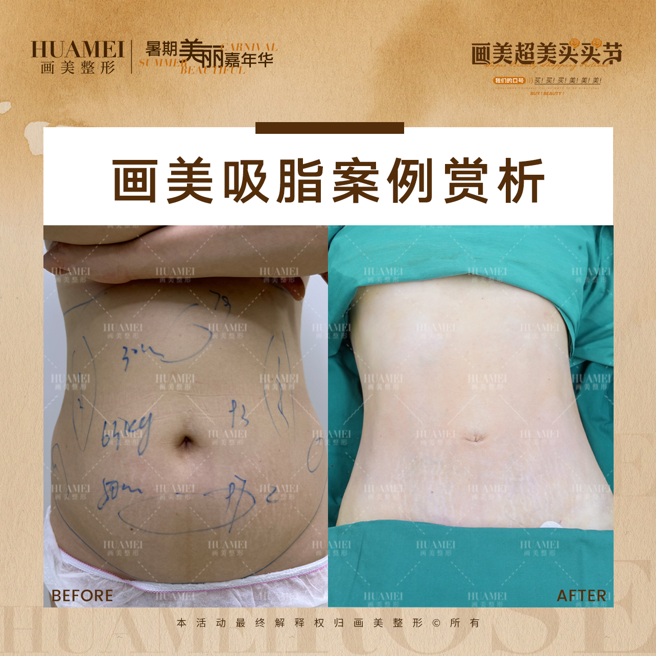 廣州雅貝壹醫(yī)療有哪些精良的吸脂手法？