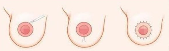 國內(nèi)縮胸手術(shù)哪里做的好？全國縮胸手術(shù)排名前三里公辦/私立醫(yī)院都有