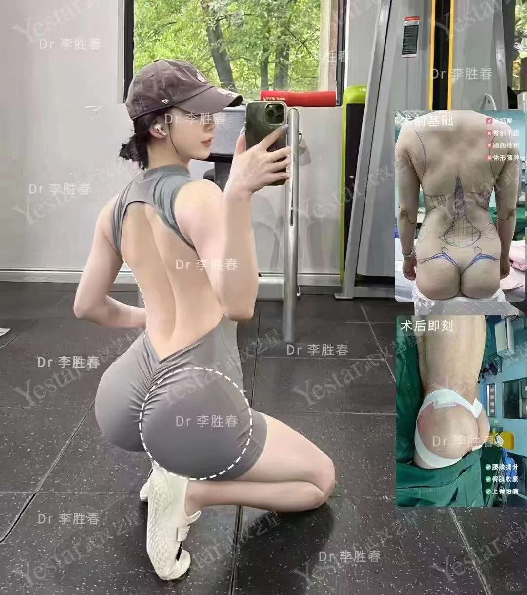 如何選擇適合自己的廣州雅貝壹醫(yī)療吸脂方案？