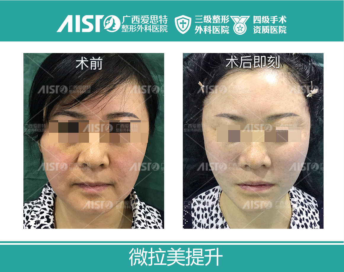 二、長沙王曉鵬醫(yī)生拉皮手術的技術特色