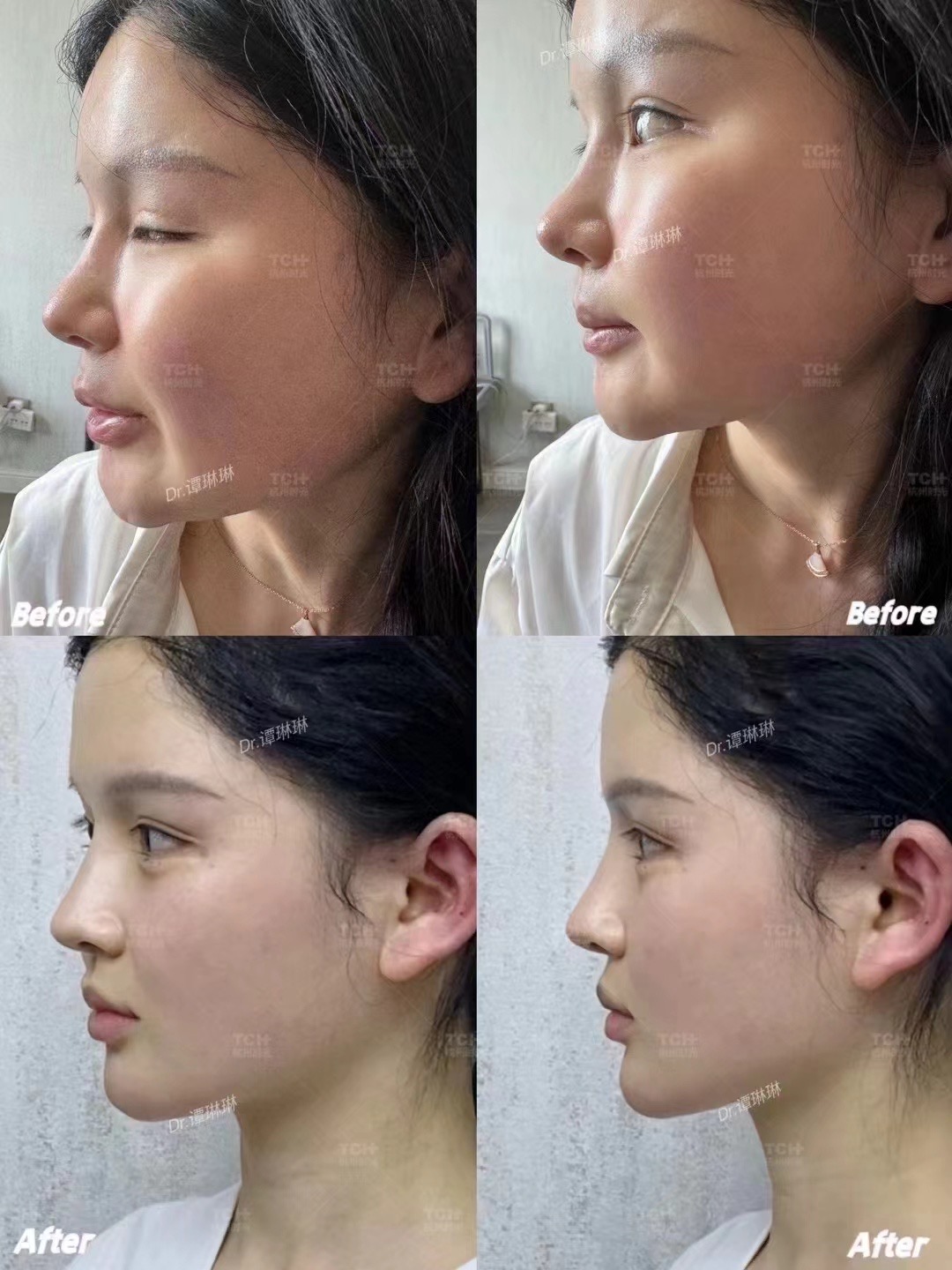 維密金雕修復(fù)蘋(píng)果肌饅化的優(yōu)勢(shì)