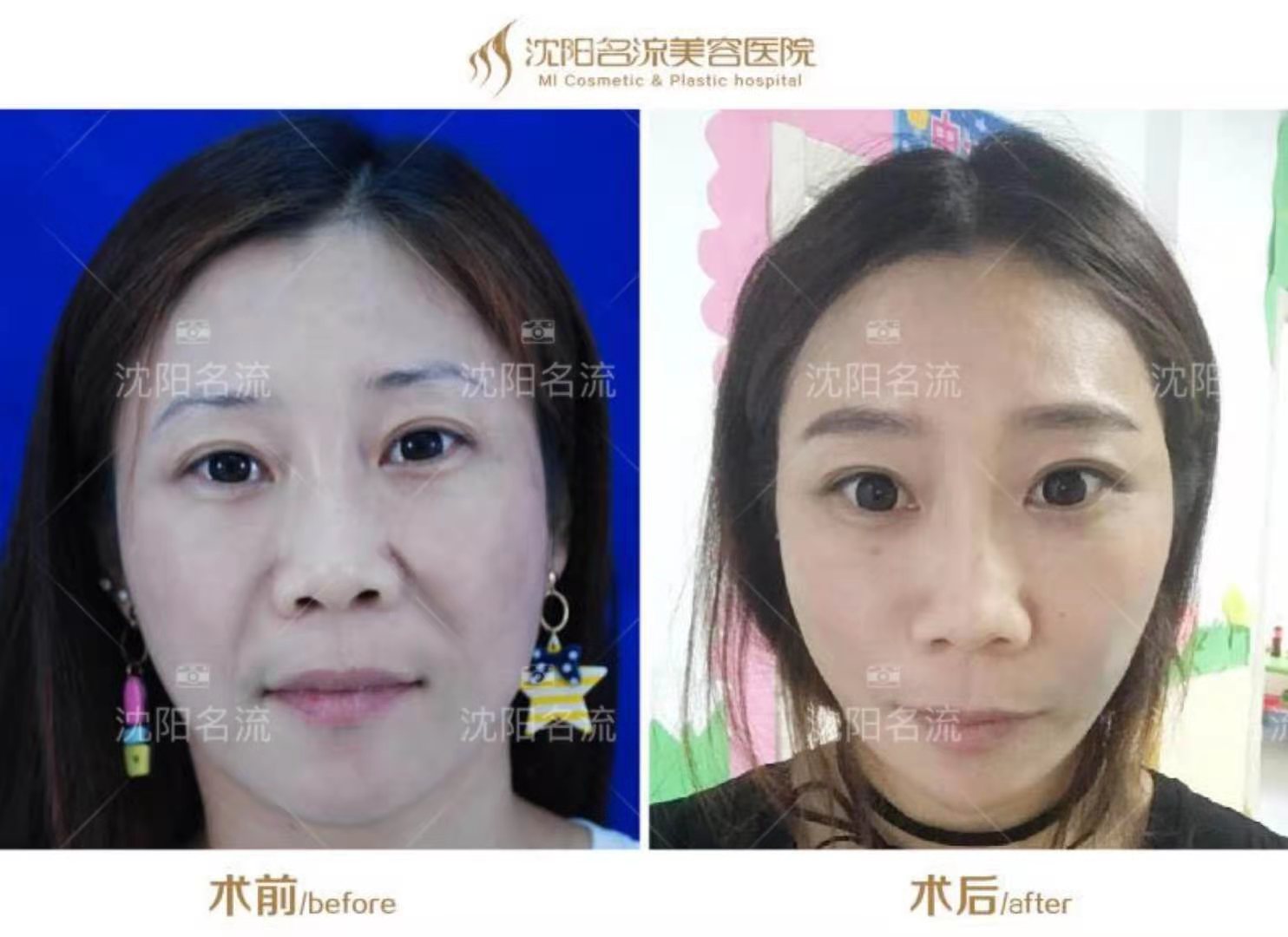 四、長沙王曉鵬醫(yī)生拉皮手術的臨床實例