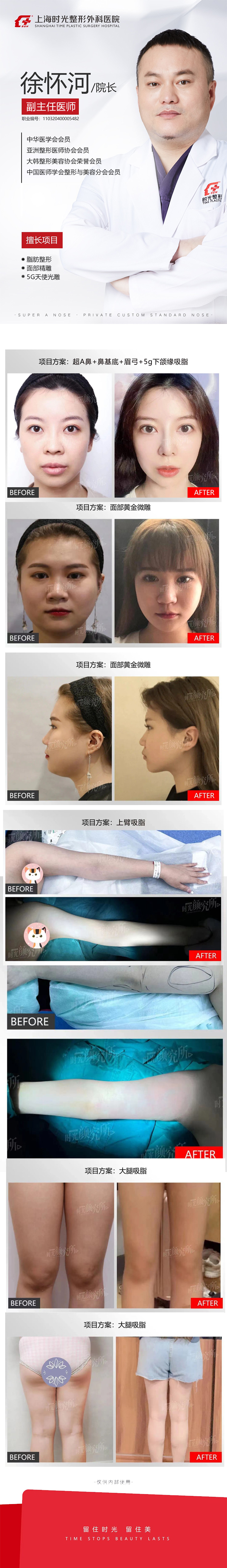 徐懷河做自體脂肪的技術(shù)不錯在哪里？