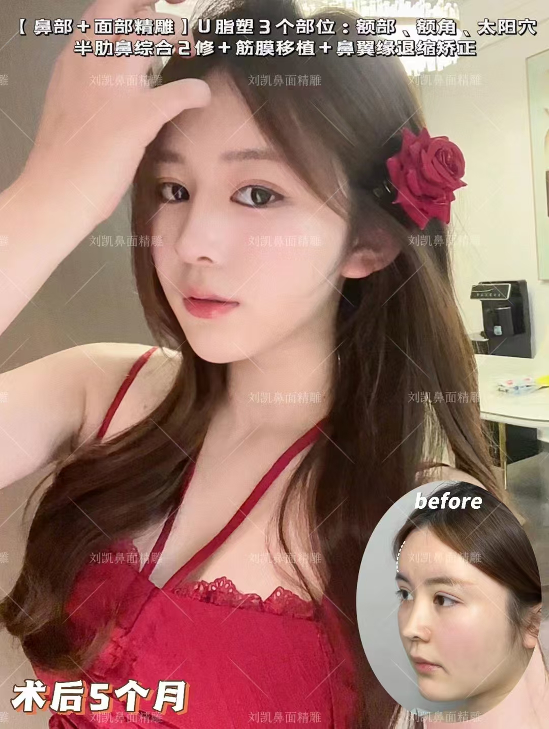 上海吳貞躍醫(yī)生修復(fù)蘋(píng)果肌饅化的技術(shù)特色