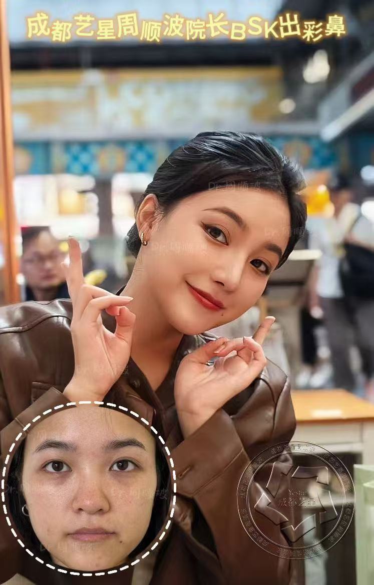 四、成都西區(qū)醫(yī)院宋華敬抽脂技術(shù)情況