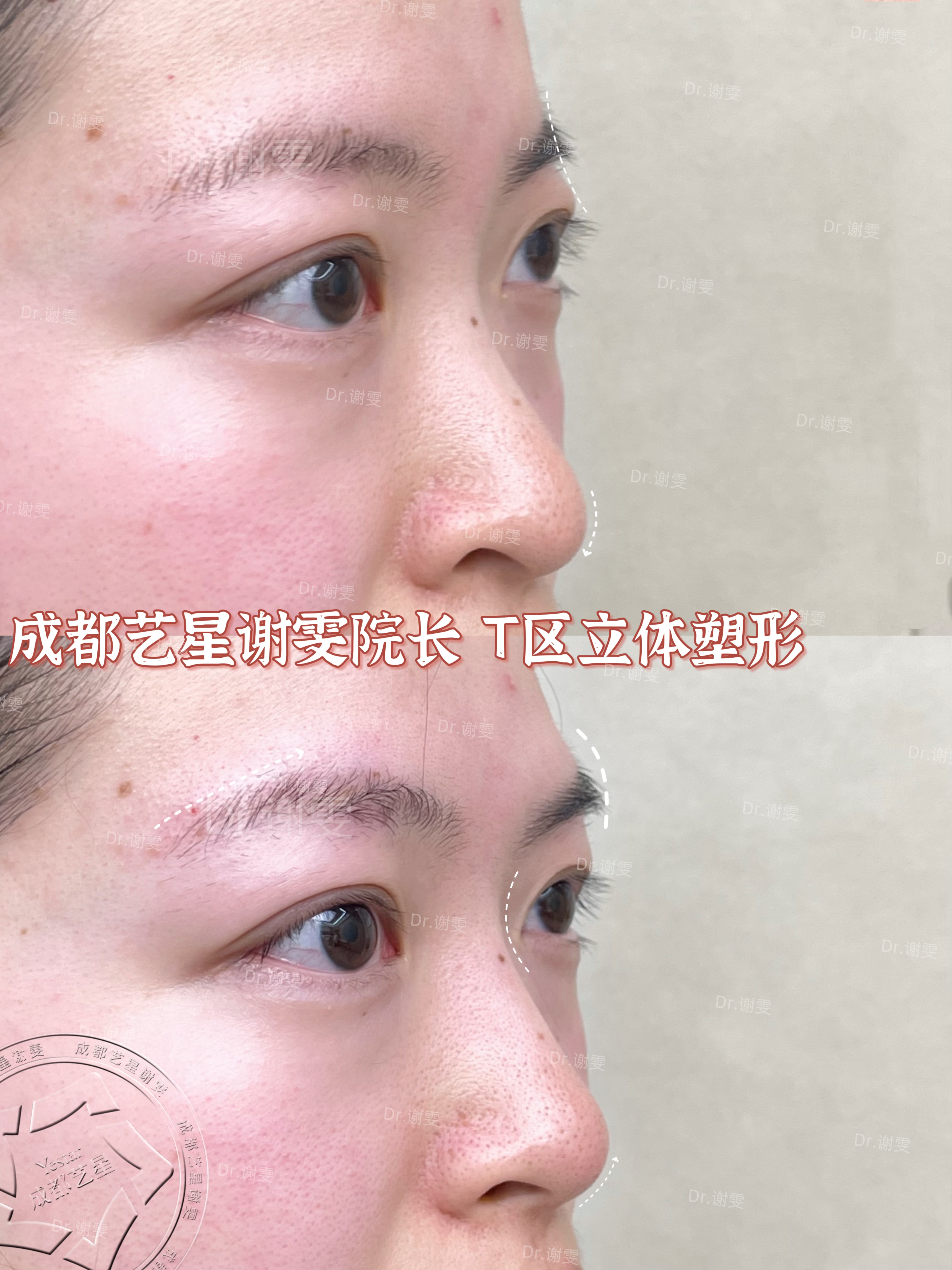 五、成都西區(qū)醫(yī)院宋華敬拉皮與抽脂實際實例