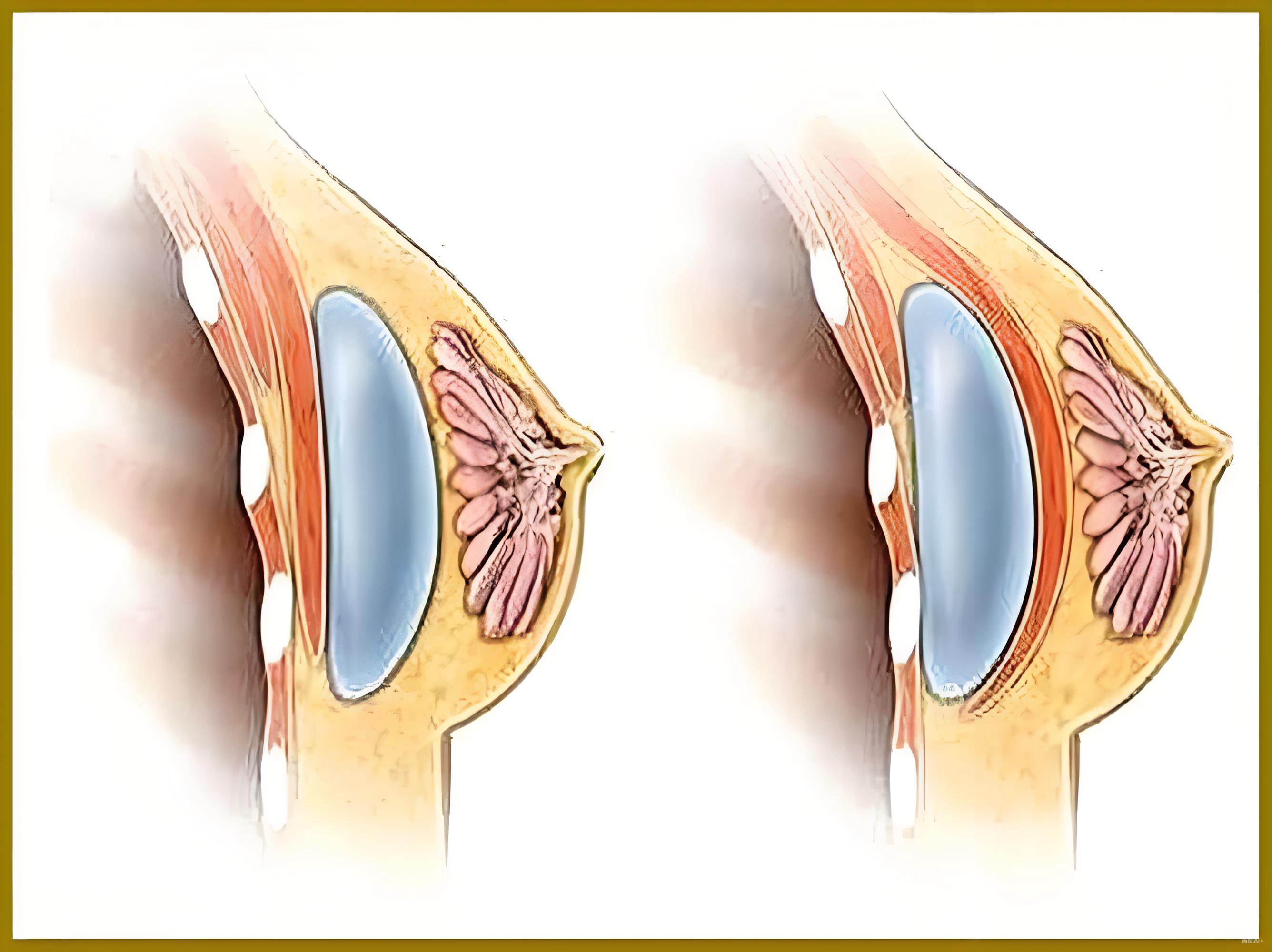 南京裴旭芳隆胸技術卻不打折