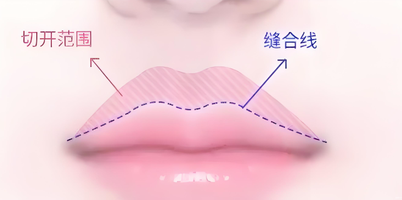 李澤唇窩加深術(shù)