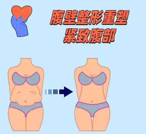 徐禮亮腹壁整形口碑咋樣