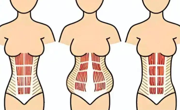 杭州腹壁整形醫(yī)生對比