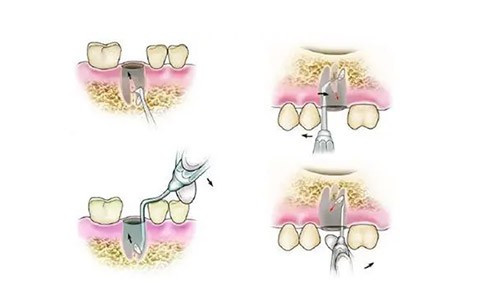 20251126114465.jpg 根管治療示意圖.jpg