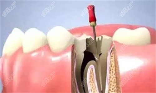 根管治療 根管治療