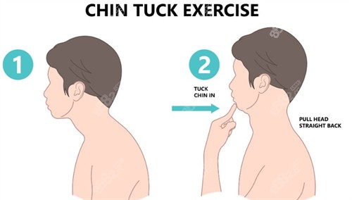富貴包矯正前后 富貴包矯正前后