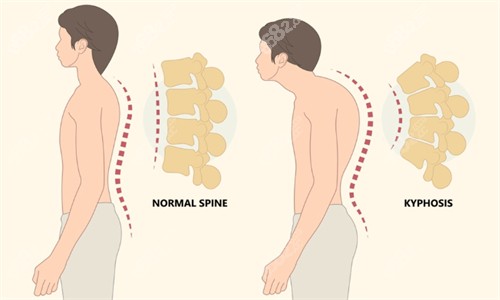 鄭州小創(chuàng)口富貴包手術哪些口碑好？美萊內窺鏡技術視野好術后很平整