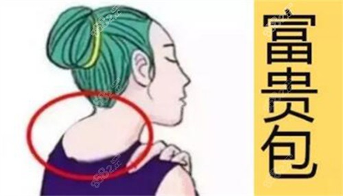 脖子富貴包卡通示意圖 脖子富貴包卡通示意圖