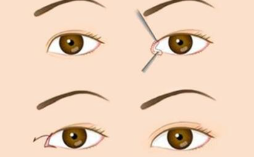 王博謙開(kāi)眼角價(jià)格