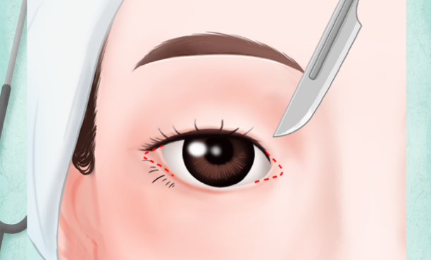 王博謙開(kāi)眼角成功實(shí)例