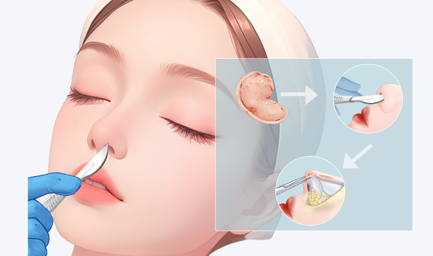 蘇州陳柳藝鼻修復價目表(內(nèi)部版)流出！鼻尖修復1.2萬+，歪鼻矯正3萬+費用無套路