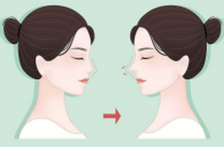 陳柳藝鼻修復(fù)真實反饋