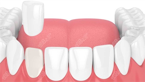 在口腔內(nèi)進(jìn)行牙齒貼面