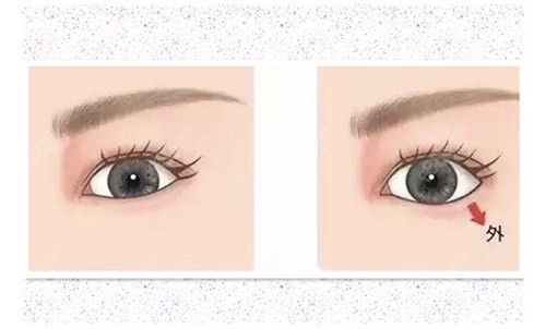 眼型矯正手術(shù)