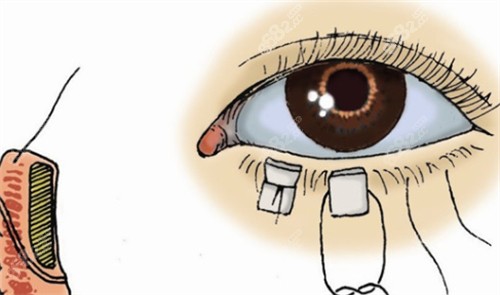 李韶瑞做眼修復怎么樣？20年專攻復雜修復|減張美容線縫合隱痕自然不僵硬