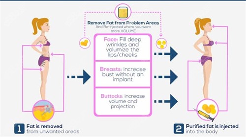 自體脂肪隆胸 自體脂肪隆胸