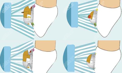 球形托槽便于清潔 球形托槽便于清潔