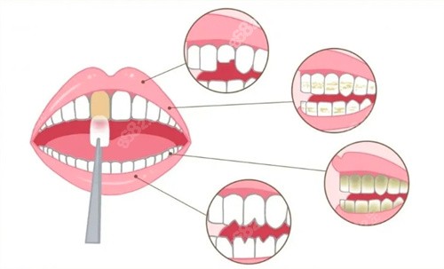 牙齒貼面示意圖