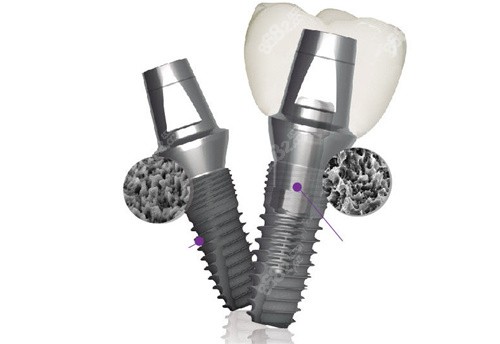 20251127814251.jpg 登騰種植牙.jpg