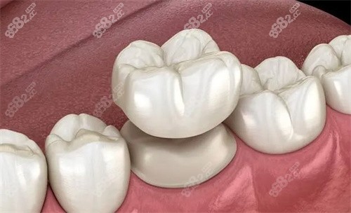 牙冠是怎么做的.jpg