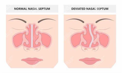 鼻修復(fù)前后
