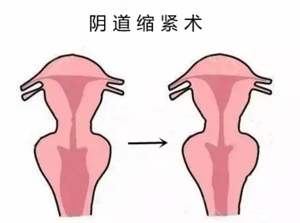 銀川緊縮手術(shù)哪家醫(yī)院做的好？寧夏華美、悅麗美、銀川微茉整形3家口碑對比