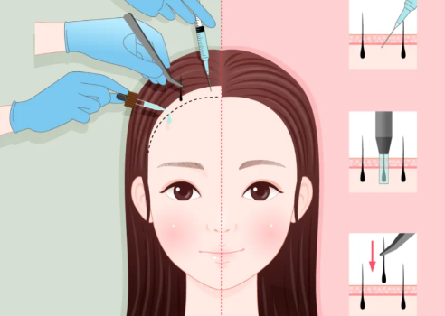 免費(fèi)毛囊檢測(cè)，專門醫(yī)生一對(duì)一設(shè)計(jì)方案