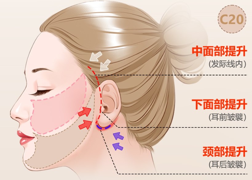 別跑空！成都李建剛筋膜提升地址：素美醫(yī)療（武侯區(qū)龍騰東路 31 號(hào)），2萬起無痕提拉3-5mm小切口