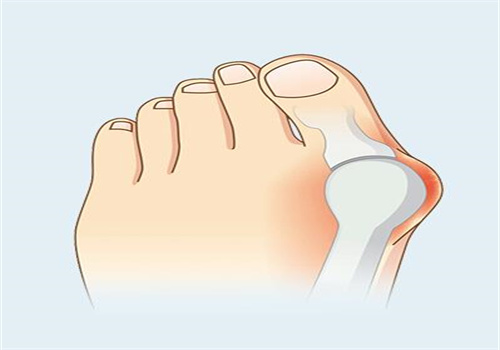 蘇敬達(dá)醫(yī)生的術(shù)式是微創(chuàng)拇外翻矯正術(shù)：0.3 - 0.5cm 切口、可吸收生物帶固定，費(fèi)用性價(jià)比高！