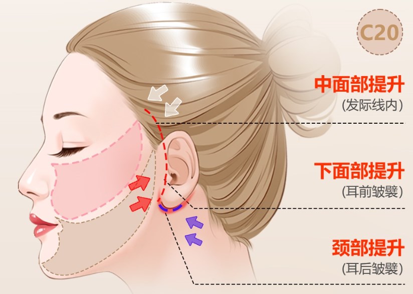 新手必看！李方奇和王闊遠(yuǎn)誰的口碑好？疑難修復(fù)選李方奇（創(chuàng)口?。?，玻尿酸過量調(diào)整沖王闊遠(yuǎn)（防松弛），北京可約