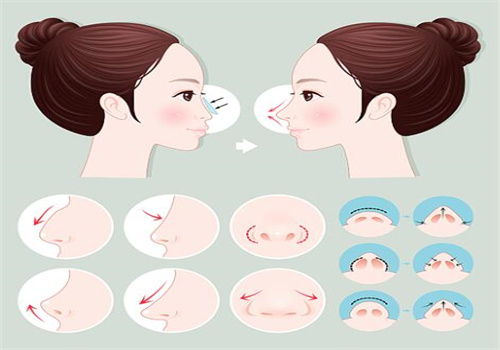 深圳張輝隆鼻醫(yī)生口碑如何？低復(fù)發(fā)率攣縮鼻修復(fù)，術(shù)后鼻尖不懼揉捏，自然挺翹獲求美者認可！