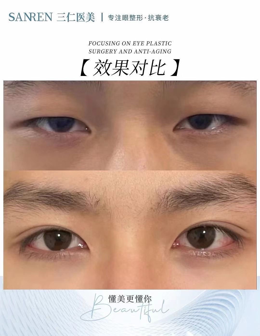 北京?，斄猪槼毖劭漆t(yī)院收費(fèi)貴嗎？全飛秒16800元起，醫(yī)生靠譜設(shè)備齊全，性價(jià)比超高！