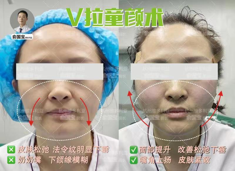 南京李啟壽的長效面部提升支架術(shù)后護(hù)理指南