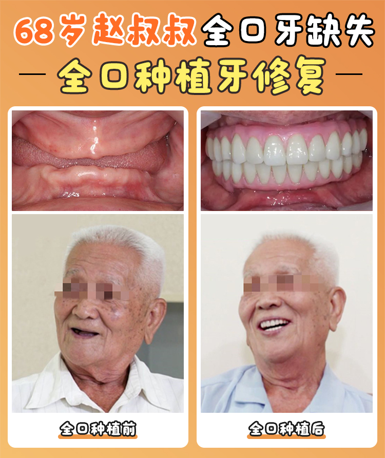 內(nèi)江啟辰口腔種植牙避坑指南