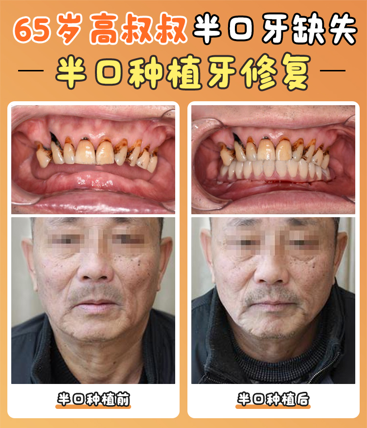 內(nèi)江啟辰口腔種植牙適合人群